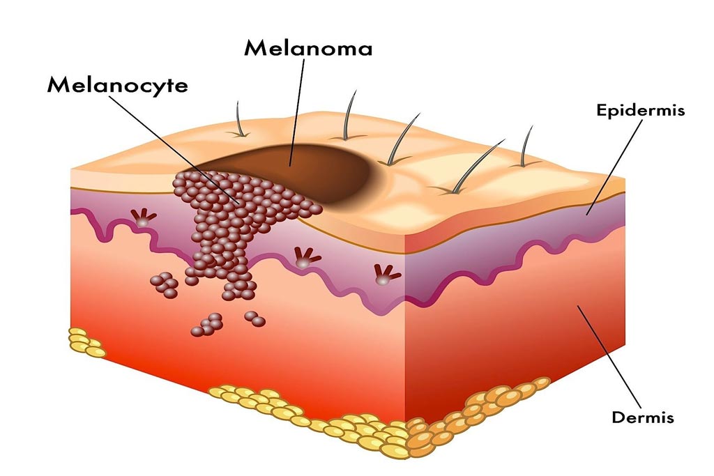 Melanoma